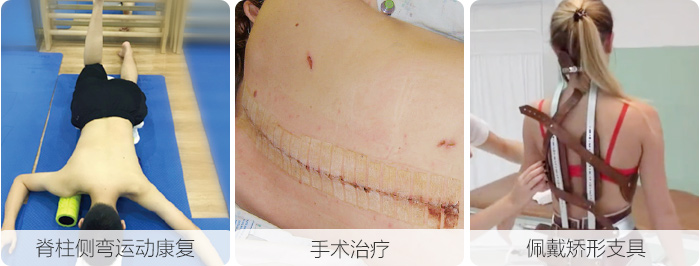 脊柱侧弯治疗方法.jpg